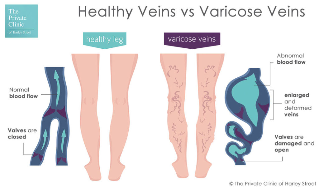 5 Yoga Poses for Varicose Veins | Varicose veins, Varicose, Learn yoga poses